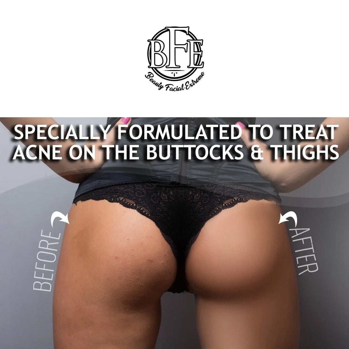 for and Prevents Breakouts. Future Acne, Buttocks Thigh Thigh Area. Anti-Acne Buttocks Away OZ Treatment- Pimples, and Ingrown & 6.9 Clears the Hairs
